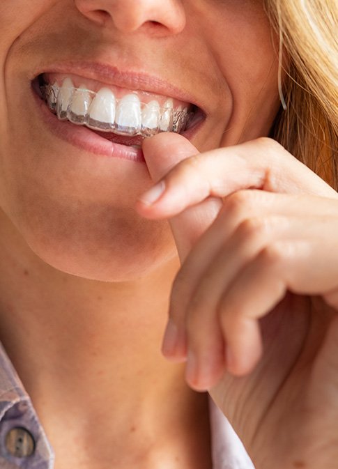 Woman putting on Invisalign tray 