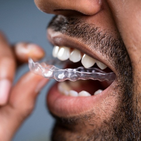 Man putting on Invisalign tray 