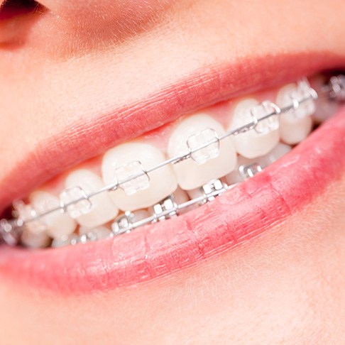 Close-up of woman with clear ceramic braces 